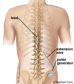 Neuroestimulador medular