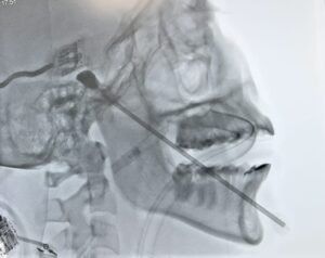 Rizotomia por Balão Neuralgia do Trigêmio