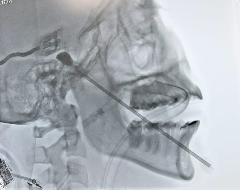 Rizotomia por Balão Neuralgia do Trigêmio